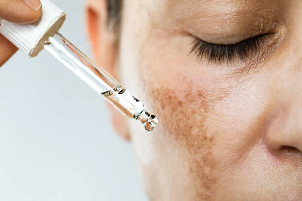 Melasma Treatment